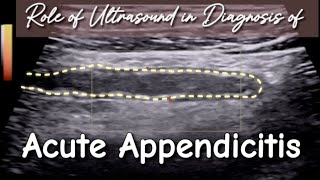 Ultrasound Acute Appendicitis  How to Prevent from False ve Diagnosis in Initial Stage [upl. by Tice]