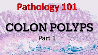 Colon Polyps  Part 1 Pathology 101 [upl. by Seibold]