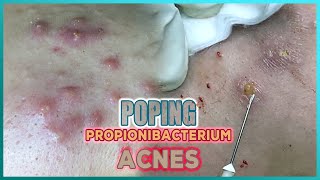 Big Cystic Acne Blackheads Extraction Blackheads amp Milia Whiteheads Removal Pimple Popping [upl. by Narol619]