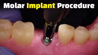 Step by Step Dental Implant Procedure  Back Molar [upl. by Ailis119]