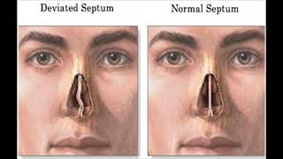 Does a Septoplasty Surgery Affect Your Singing Voice [upl. by Lehacim]