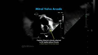 Mitral Valve Arcade on Echocardiogram Shorts echocardiography Hammock Mitral valve cardiology [upl. by Namialus621]