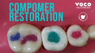 Compomer Restoration Pediatric Restorative Twinky Star  VOCO GmbH [upl. by Holcomb]