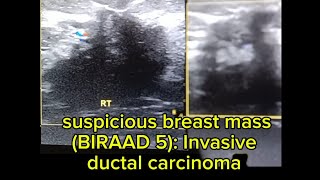 ultrasound of suspicious breast mass BIRAD 5 Invasive ductal carcinoma [upl. by Zosema]