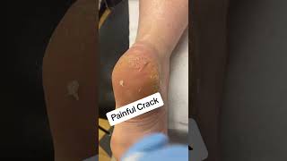 Thick cracked and painful heel callus removal by a podoatrist [upl. by Adnolaj]