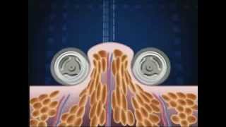 How Endermologie® works lipomassage [upl. by Tremann106]