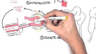 Chronic Kidney Disease CKD Pathophysiology [upl. by Ripp]