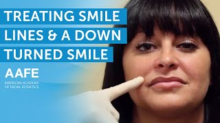 Treating Smile Lines and a Downturned Smile  AAFE [upl. by Norris]