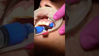 Crown Placement DentalCrown DentalCare SmileMakeOver Veneers Cancun DentalTourism [upl. by Pyszka271]