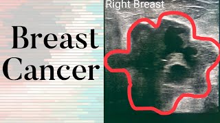 Breast Cancer  What Does Breast Cancer Look Like on an Ultrasound [upl. by Attennaej]