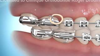 orthodontie et élastiques pour corriger une malocclusion clIII [upl. by Aneetak]