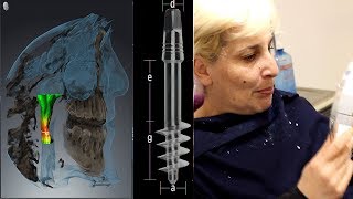 Implant dentaire basal 2  Témoignage douleurs opération avis [upl. by Ithnan]