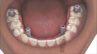 AllOn4 Dental Implants Coventry Best Same Day Full Whole Mouth Teeth Implants At Verum Dentists [upl. by Abrahams]