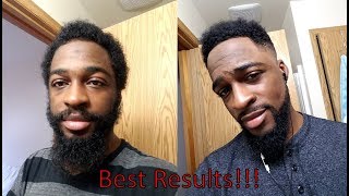 5 minoxidil journey update  Week 19 [upl. by Ricca]