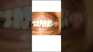 Anterior tooth restoration and crown placement [upl. by Attiuqihc]