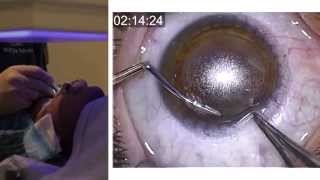 London Vision Clinic  ReLEx SMILE  Live laser eye surgery  Professor Dan Reinstein [upl. by Trixi694]