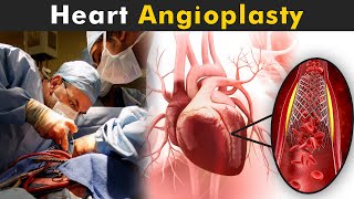 How Angioplasty Procedure Is Performed  Balloon Angioplasty And Coronary artery stent UrduHindi [upl. by Ibor]