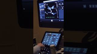 Heart Echo Ultrasound echocardiogram in Progress 120823 [upl. by Nepsa]