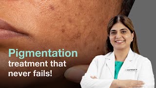 Get rid of pigmentation with Cureskin skin treatment  SkinHaiMazakNahi [upl. by Hoy693]