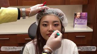 Gummy Smile Botox  Nose and Lips Improvement by injection only  Dr Valaie MD [upl. by Ytineres]