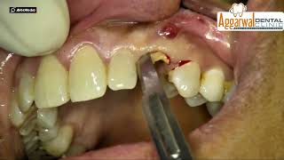 Immediate implant placement with TSIII CA implant and GBR using A Oss Collagen [upl. by Iorio]