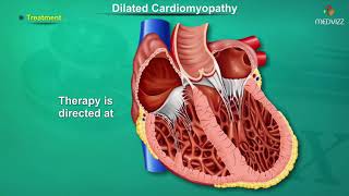 Dilated cardiomyopathy  DCM   Causes Signs and Symptoms Pathogenesis Diagnosis and Treatment [upl. by Marjorie]