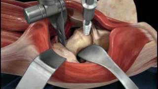 Direct Anterior Approach Hip Replacement [upl. by Tyler644]