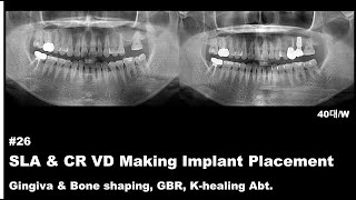 26 SLA amp CR VD Making Implant Placement Gingiva amp Bone shaping GBR Khealing Abt [upl. by Liahkim428]