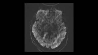 MRI BRAIN TBI Set 7 [upl. by Cicero]