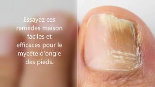 Comment jai soigné ma mycose des pieds facilement et naturellement  Allez Santé [upl. by Rask]