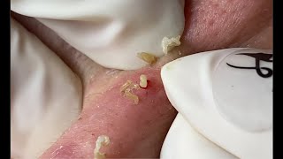 Acne Treatment Huong Da Nang  590 [upl. by Noxaj145]