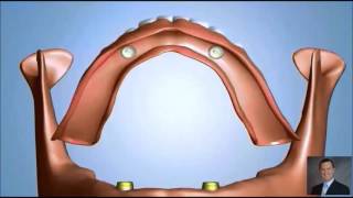 Two Implants  Locator Attachement for Denture [upl. by Nashbar]