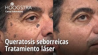 Queratosis seborreicas  Tratamiento láser  22340 [upl. by Nnairda]