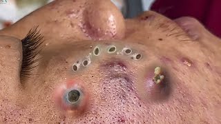 Big Cystic Acne Blackheads Extraction Blackheads amp Milia Whiteheads Removal Pimple Popping 090 [upl. by Ellohcin434]