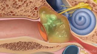 Ruptured eardrum perforated eardrumTreatment for eardrum rupture [upl. by Asilrak225]