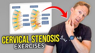 5 Exercises for Cervical Stenosis Arm Nerve Pain [upl. by Tnirb]