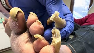 Unbelievable Toenails so long and painful that patient cannot walk [upl. by Yehsa446]