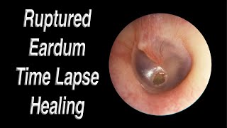 Ruptured Eardrum Healing Closed Time Lapse  A Hole in Eardrum Usually Heals Closed on Its Own [upl. by Finegan409]