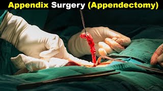 How Does Appendectomy Works  Appendicitis treatment UrduHindi [upl. by Mimi]