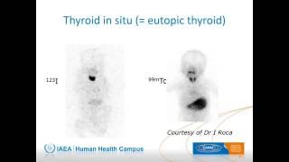 IAEAESNM Webinar  Thyroid Scintigraphy in Children in Spanish [upl. by Volin]