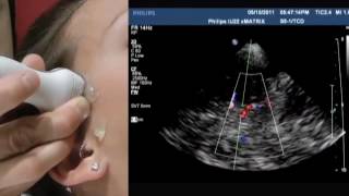 How To Transcranial Doppler [upl. by Janaya]