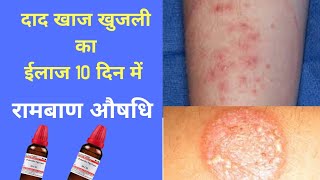 दाद की सबसे अच्छी दवा दाद का ईलाजHomeo medicine for ringworm [upl. by Luci]