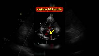 Amplatzer Septal occluder as seen on Echocardiogram echocardiography heart asd [upl. by Rafaj]