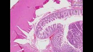 Histopathology Colon Adenocarcinoma [upl. by Teresa]