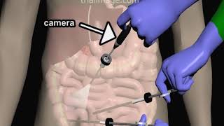 Laparoscopic Appendectomy  Animation by Cal Shipley MD [upl. by Sargent]