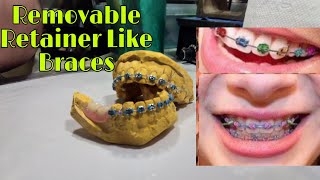 Retainer Like braces sa Pustiso Pustiso with braces na may Ngipin Dental Braces in The Philippines [upl. by Liborio]