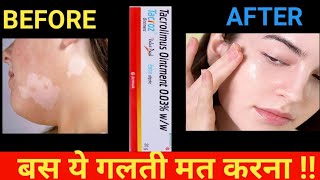 tacroz ointment use in hindi  tacrolimus ointment [upl. by Eivol950]