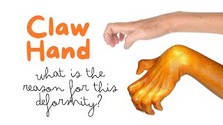 Claw hand is due to paralysis of what muscles Reason for clawing of hand handdeformity clawhand [upl. by Goldfarb]