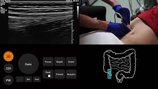 Ultrasound Tutorial AppendixAppendicitis  Radiology Nation [upl. by Hummel]