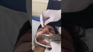 Nasal Packing Removal  3rd day after surgery [upl. by Yxor468]